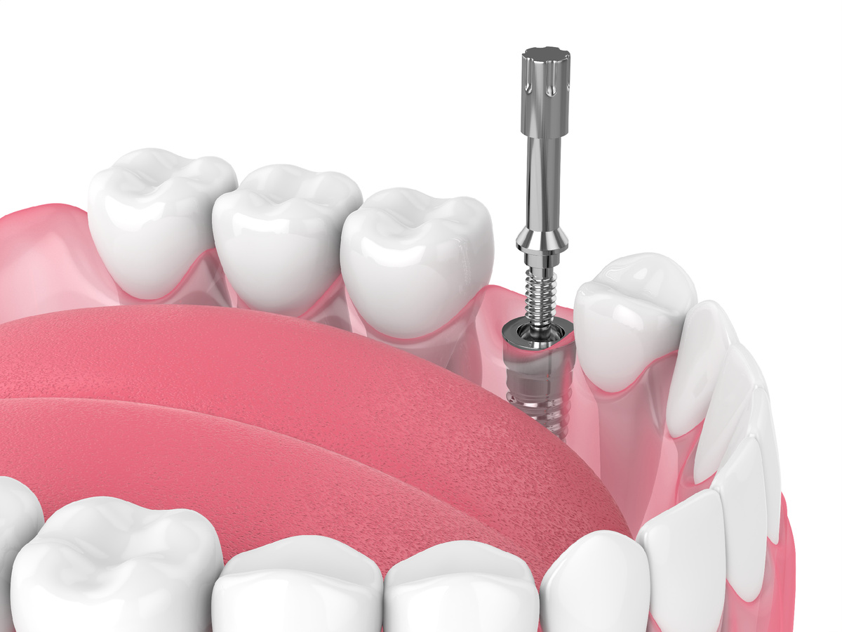 Зубной имплантат