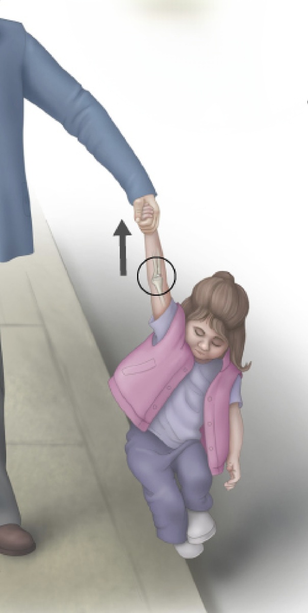 Изображение взято из статьи: Radial head subluxation (pulled elbow): Evaluation and management. Authors: Brian R Moore, MD, Joan Bothner, MD