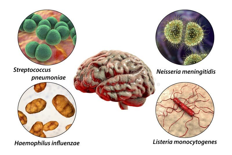 Etiology of Bacterial Meningitis