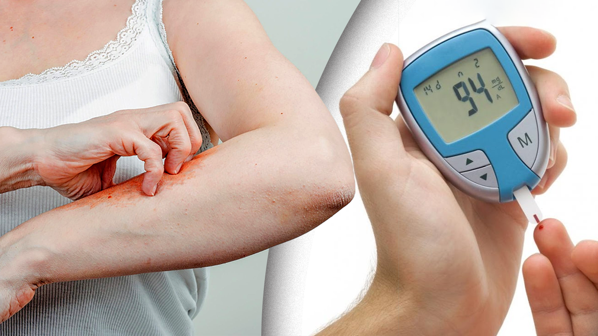 Зуд и сухость кожи при диабете: домашние лайфхаки для диабетиков с сухой кожей