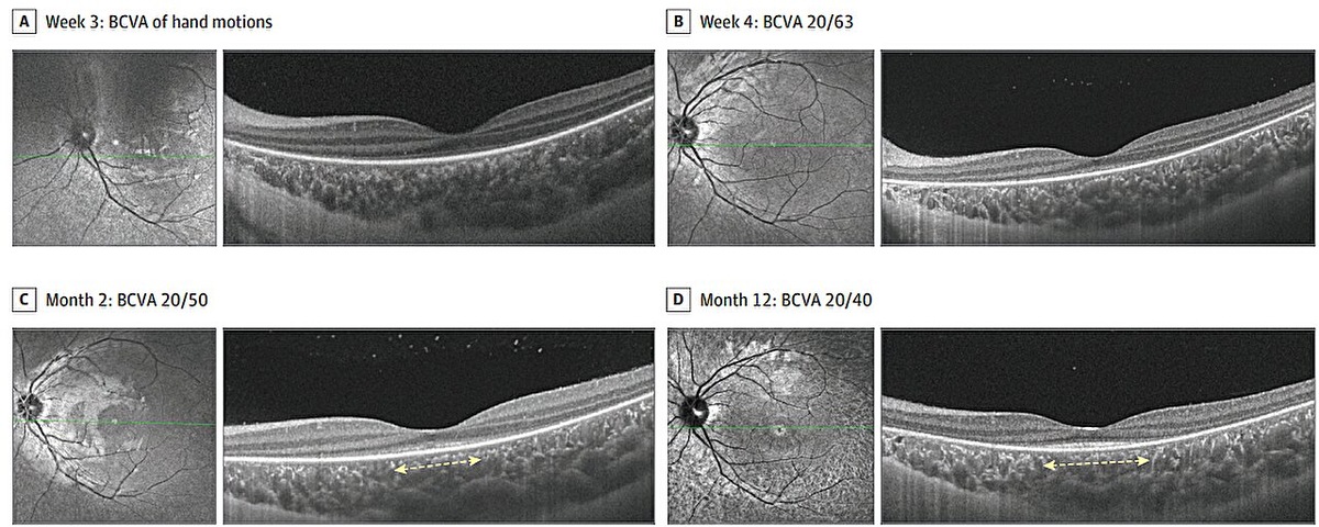   Yizhe Cheng et. al / JAMA Ophthalmology, 2025