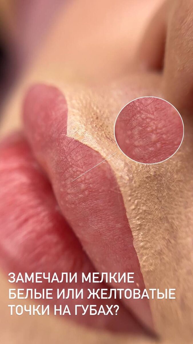 Гранулы Фордайса