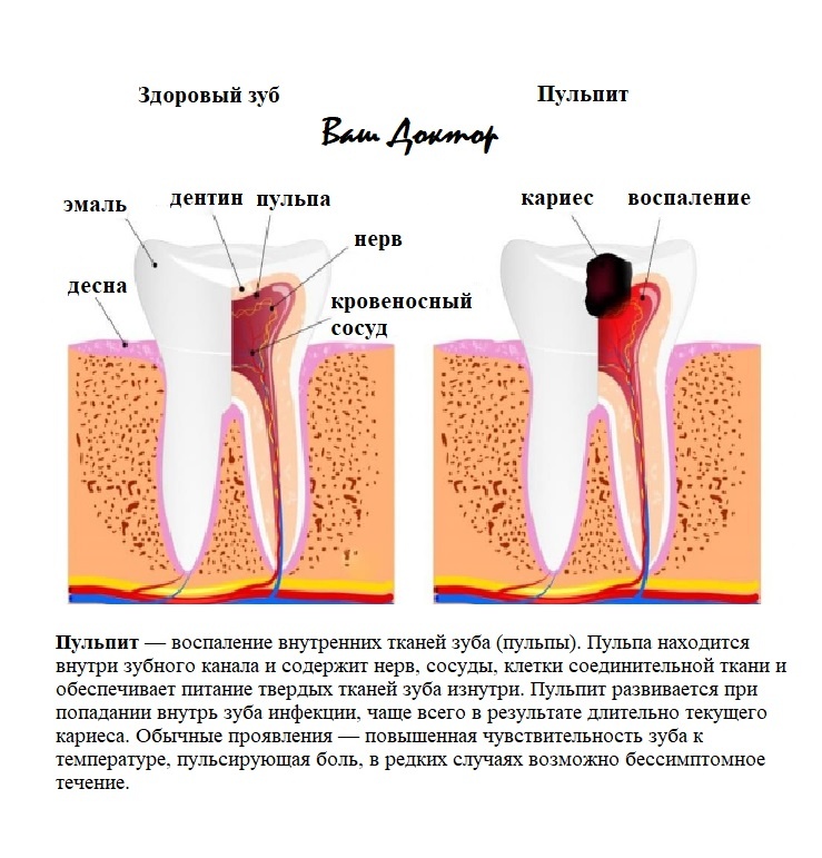 Что должен знать человек о заболевании зубов? - всё, что может его коснуться рано или поздно, поэтому сейчас про пульпит - знайте!