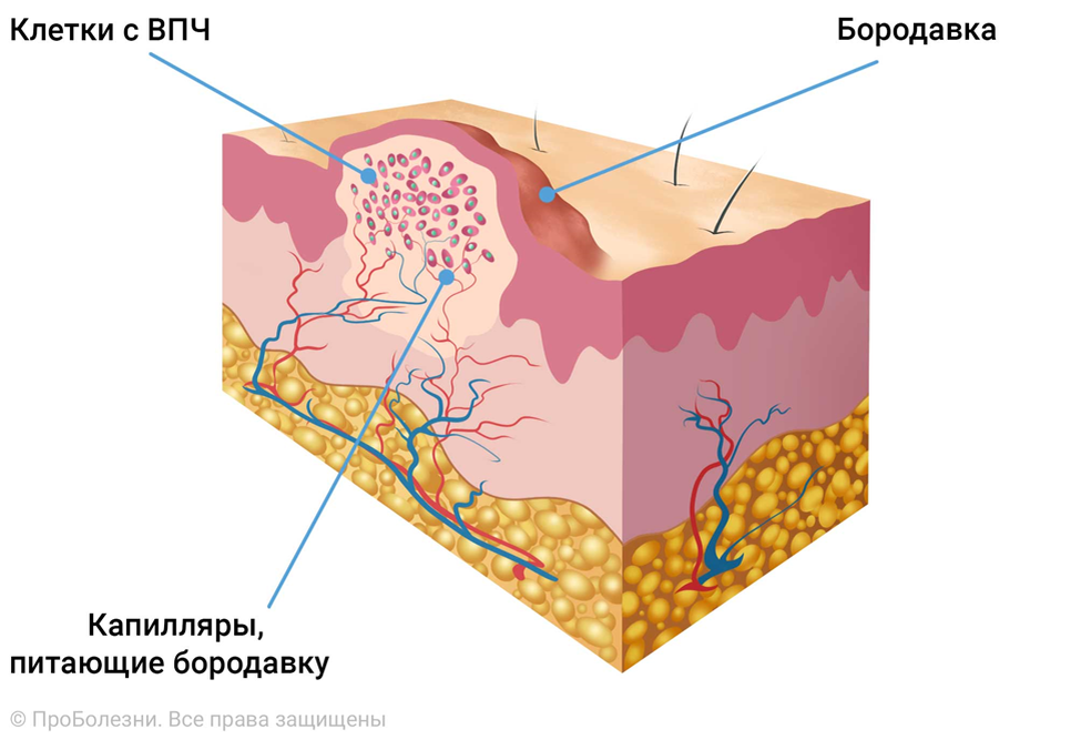 Гистология бородавки