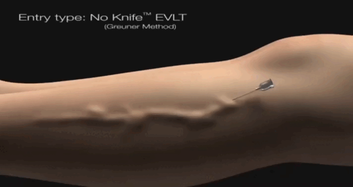 В больную вену устанавливается специальный катетер и через него в вену заводится лазерное волокно, затем мы делаем несоклько обезболдивающих уколов вдоль больной вены (этот этап не показан на видео) и включаем лазер. Вена запаивается и рассасывается