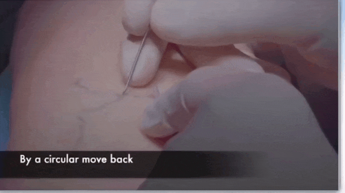 После обезболивания делается прокол иглой от шприца и больная вена захватывается специальными интсрументами и аккуратно подтягивается