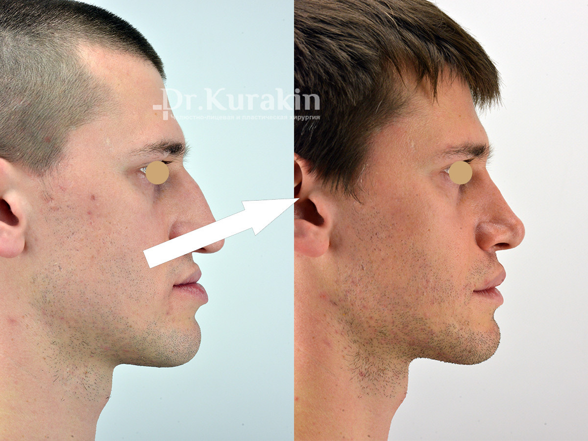    Мьюинг и челюсти: почему мужчины одержимы мощными лицами?