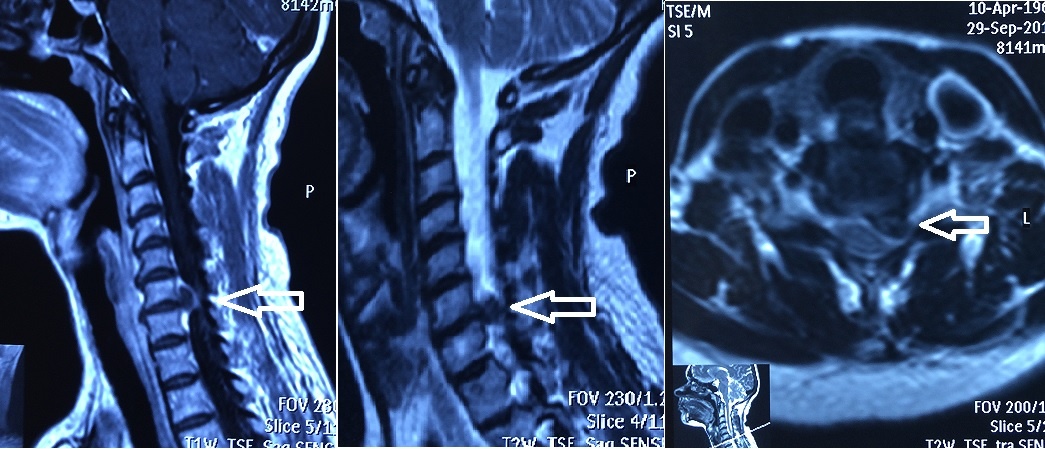 Большая грыжа со сдавлением корешка и спинного мозга