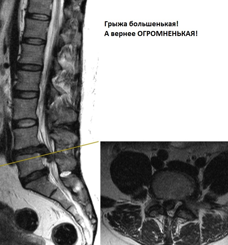 Боооольшая грыжа диска