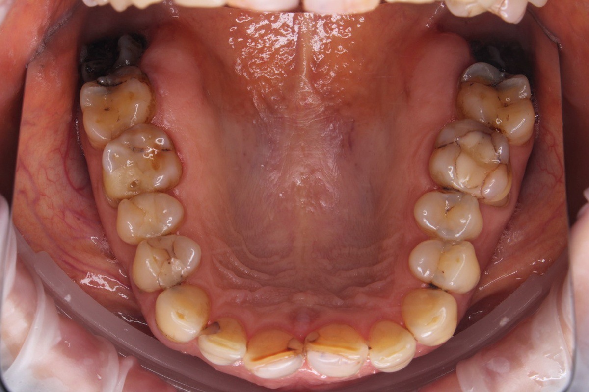 До лечения пациента (клиники ЭкоДент)