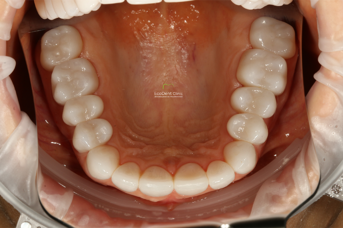 После лечения (клиника ЭкоДент)