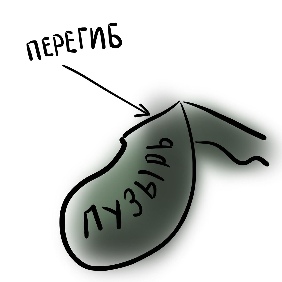 Перегиб желчного пузыря