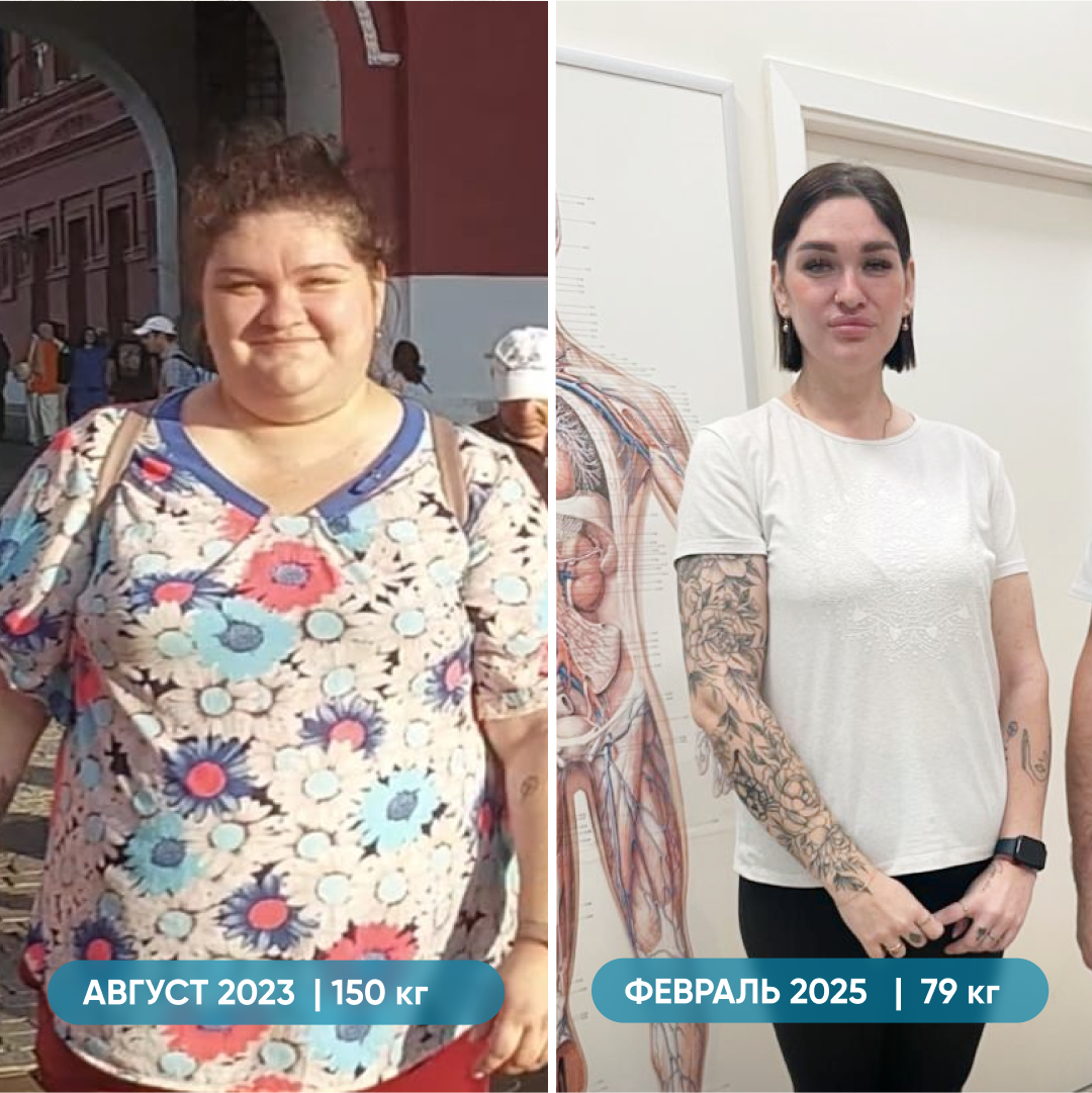 До и после продольной резекции желудка