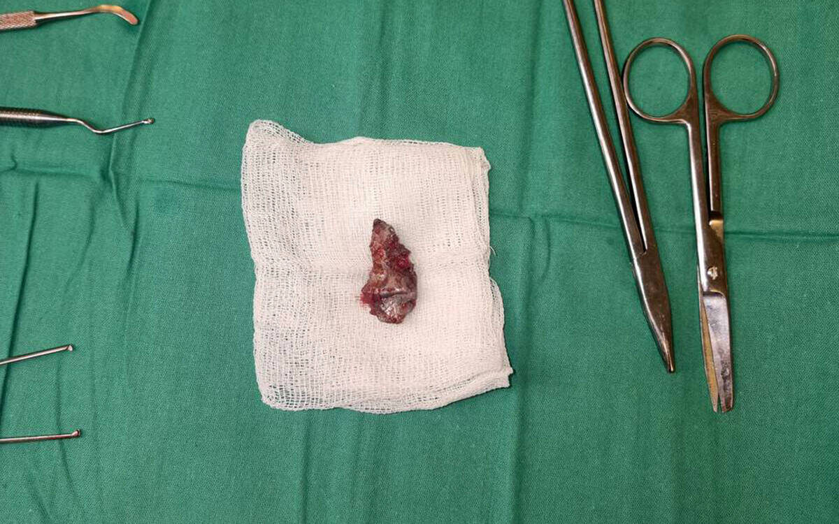 Врачи достали из щеки Андрея осколок размером примерно 3 на 4 сантиметраФото: пресс-служба РКБ