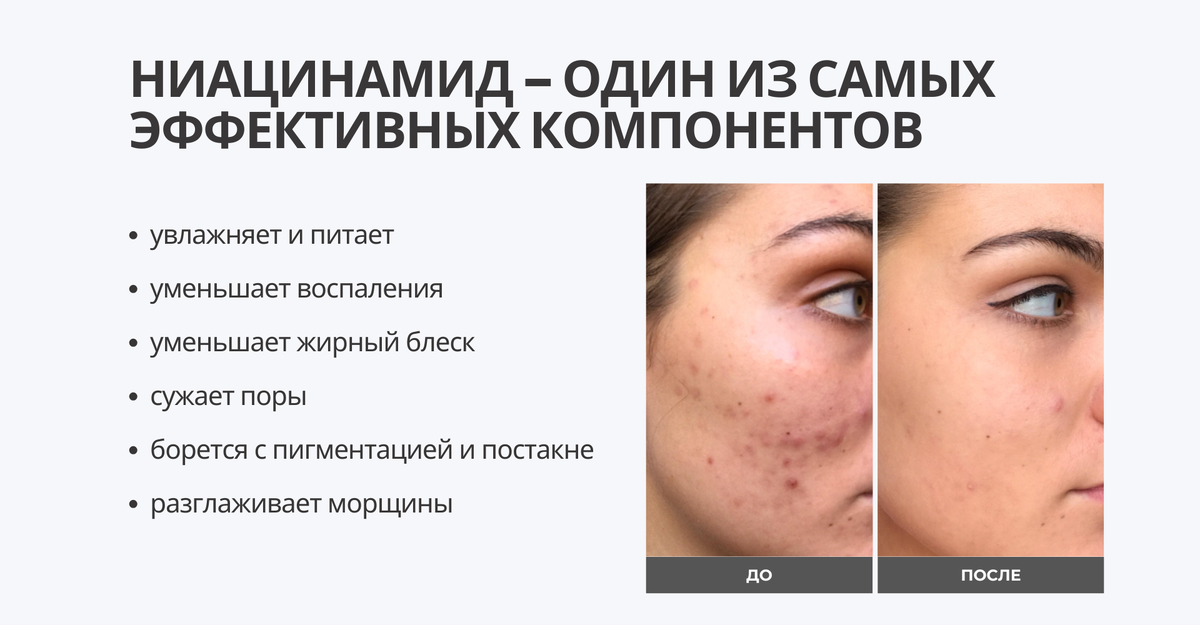 ниацинамид – один из самых эффективных компонентов