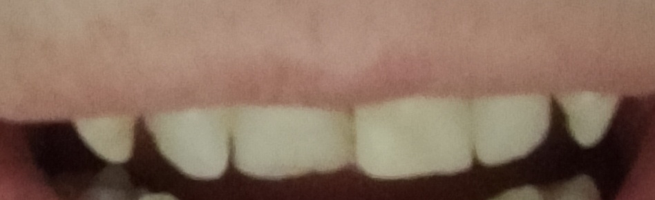 На зубе,который меньше,пломба стоит уже почти три года. А на том,который больше - выпадает. Первый раз делали сразу на два. Видно,что уже половину зуба сточили.