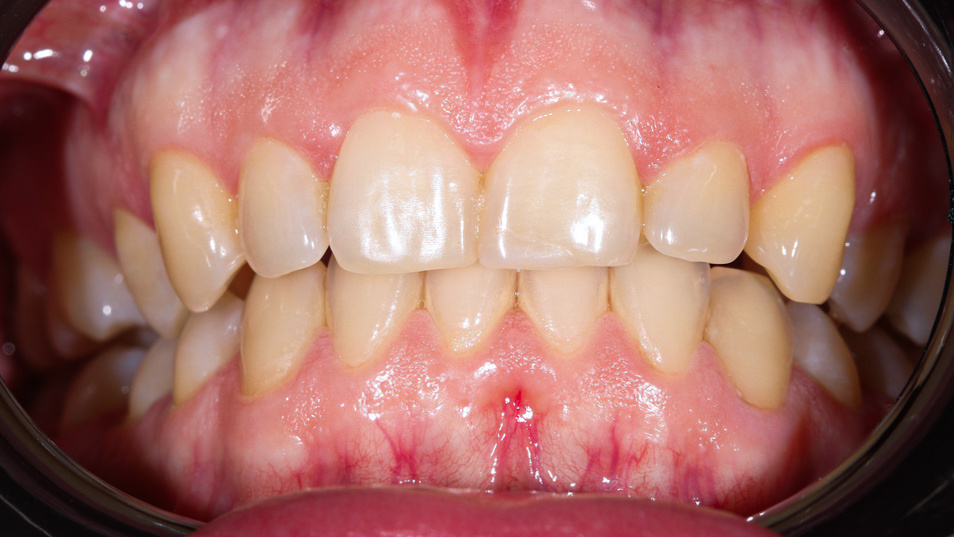 Зубы Анастасии ДО 