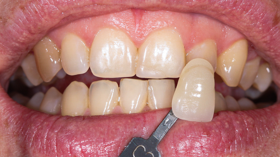 Исходный цвет зубов Анастасии