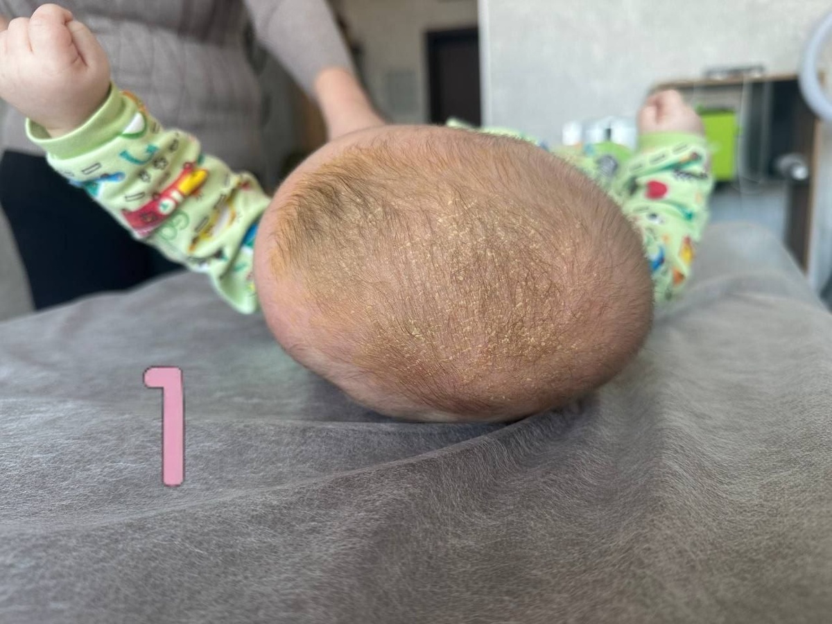 Плагиоцефалия (деформация и асимметрия черепа) и почему она возникает. Артур Сабуров, детский врач, остеопат