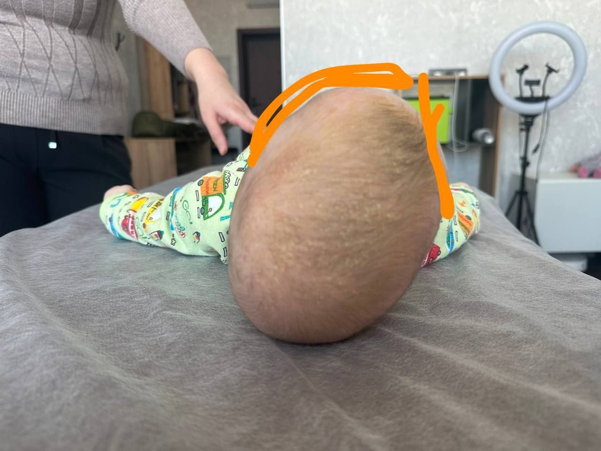 Асимметрия черепа (плагиоцефалия) у новорожденных. Артур Сабуров, детский врач, остеопат