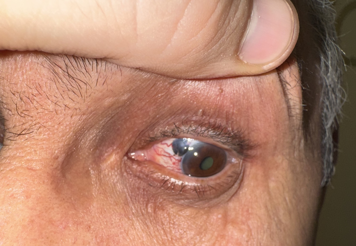 Пятно черного цвета - это меланома. Активное клеточное деление требует большого количества энергии, для получения которой опухоль активно кровоснабжается - в этом причина расширения кровеносных сосудов, идущих к опухоли.