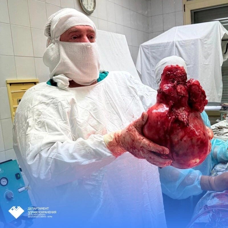    В Сургутской городской больнице успешно провели операцию по удалению гигантской миомы