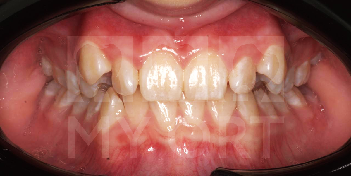 Улыбка пациентки ДО ортодонтического лечения