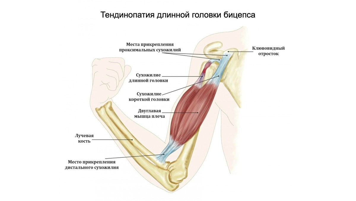 Тендинопатия длинной головки бицепса