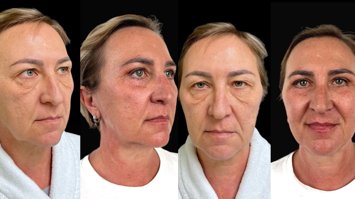 erid: 2W5zFK7N4S4 9 месяцев после блефаропластики верхних и нижних век. Пластический хирург Атаманов Дмитрий Константинович.