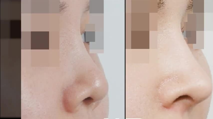 *пример ринопластики по увеличению носа в Корее