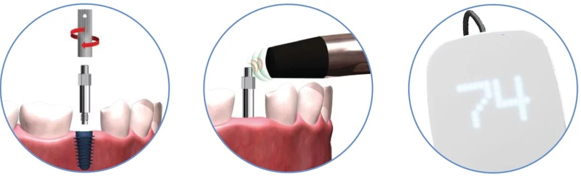 Оценка стабильности имплантата в кости с помощью аппарата
