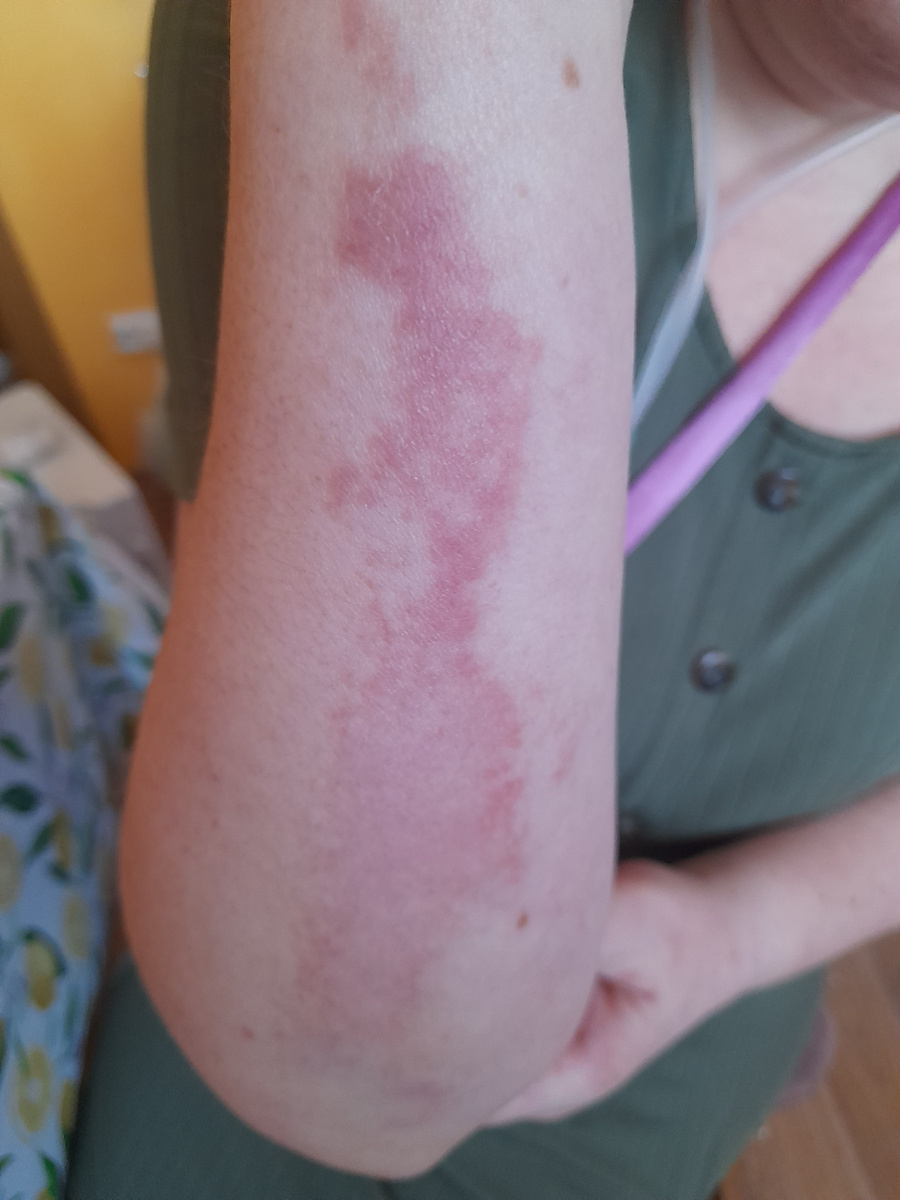 Вот такие покраснения на руках, крем Акридерм гк спасает 