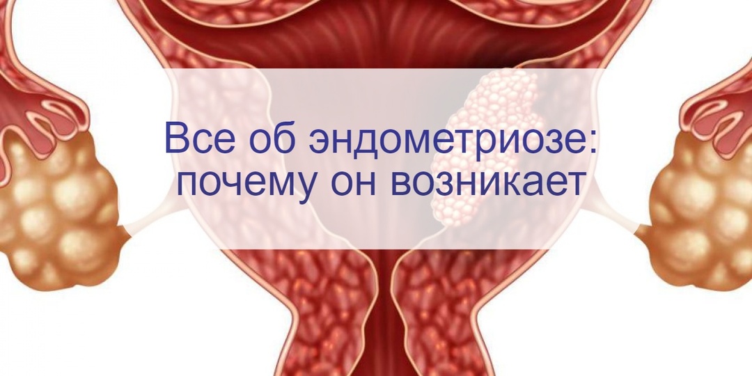 Все, что вы хотели знать об эндометриозе, но не знали – где спросить: часть 1 – что это такое и почему возникает