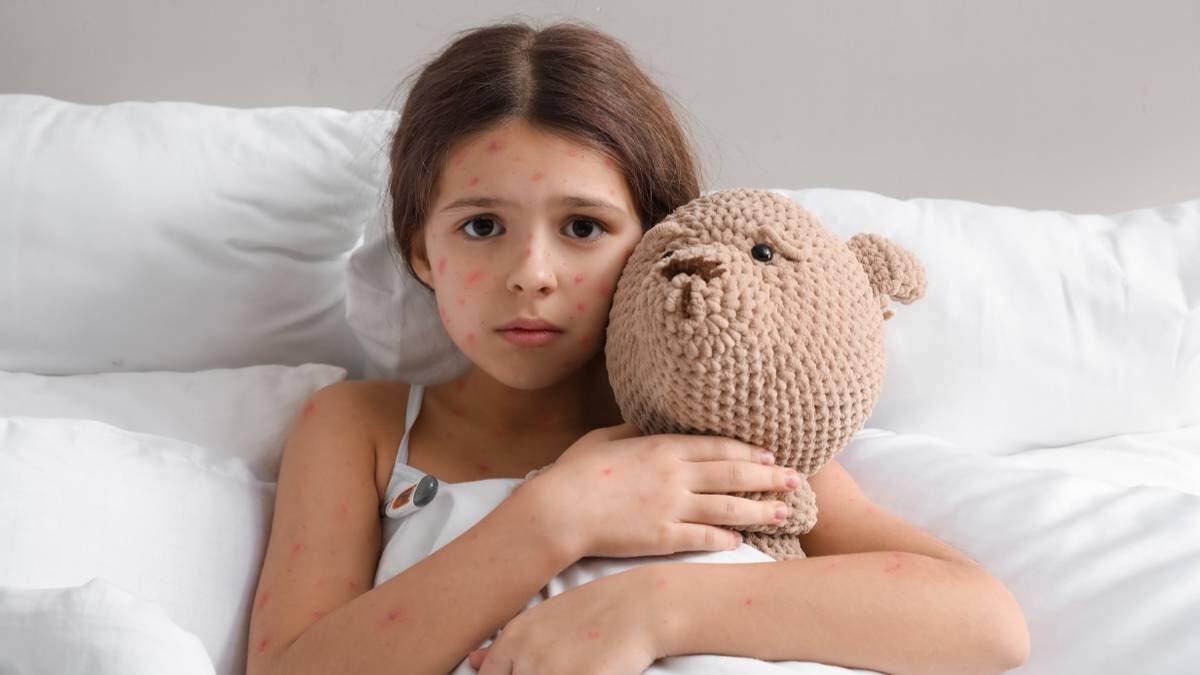    Основной признак ветрянки у детей — это красные высыпания на коже и высокая температура / Фото: Shutterstock