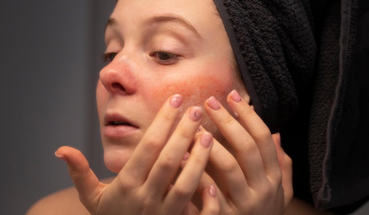     Шелушится кожа на лице: 5 причин и способов решить проблему