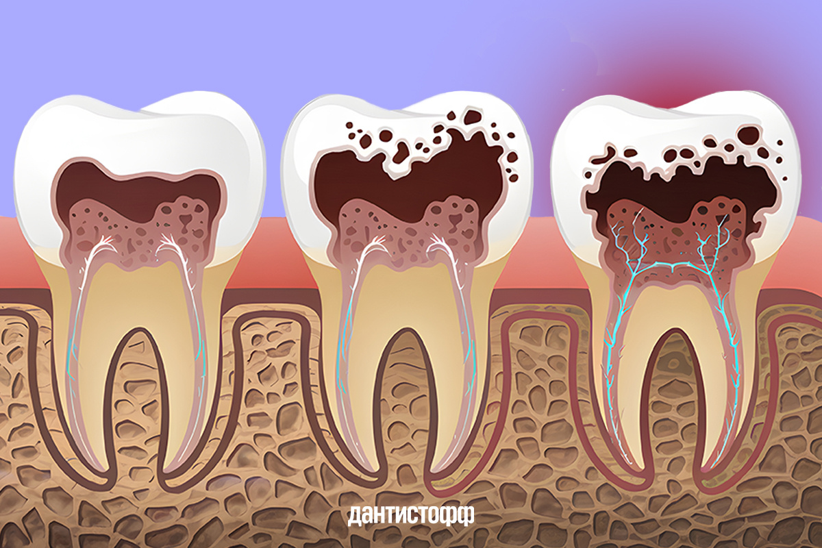 Стадии кариеса