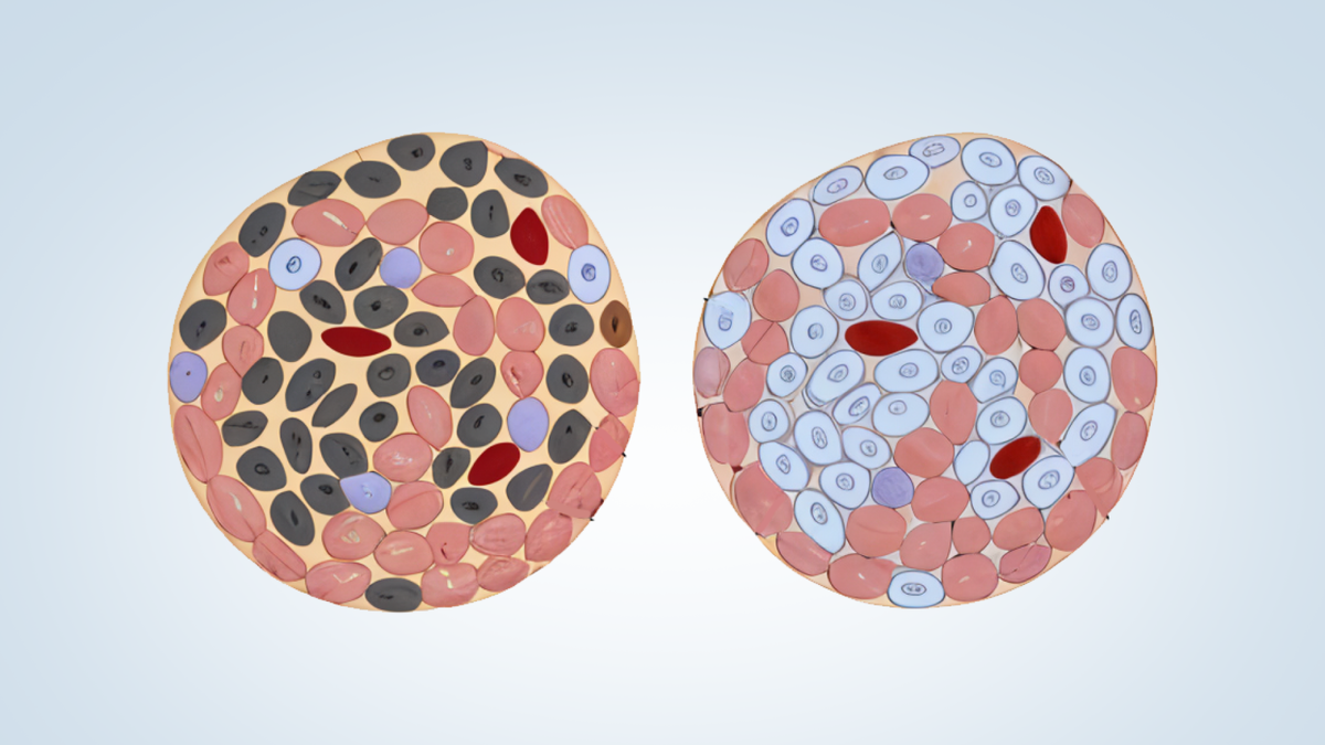 некроз клеток поджелудочной и здоровые клетки