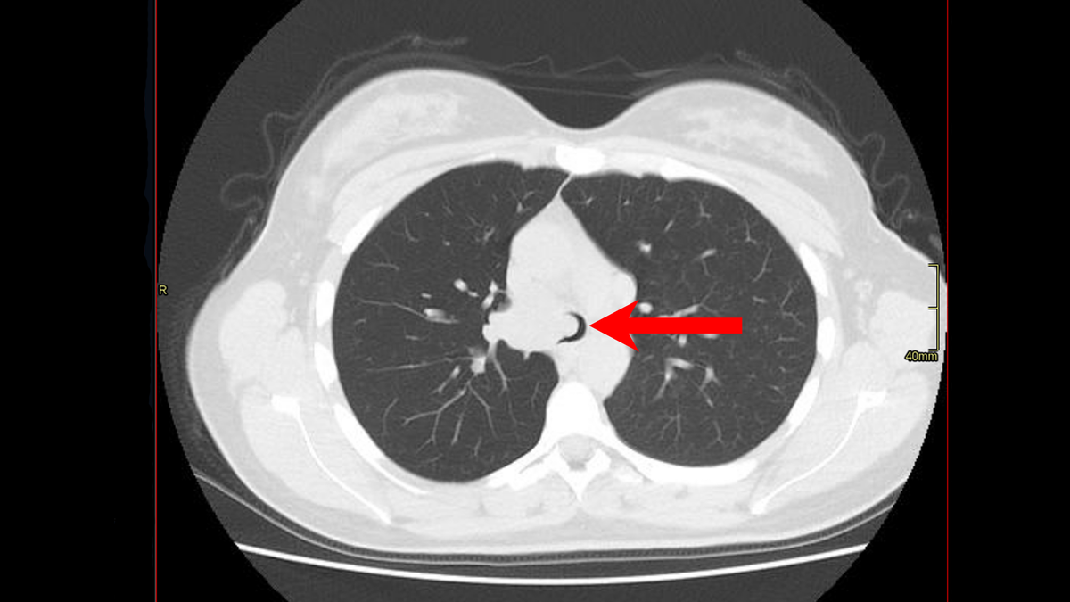 Обструкция трахеи. Черным цветом отображается оставшийся щелевидный просвет трахеи. Воздух поступает только через него.