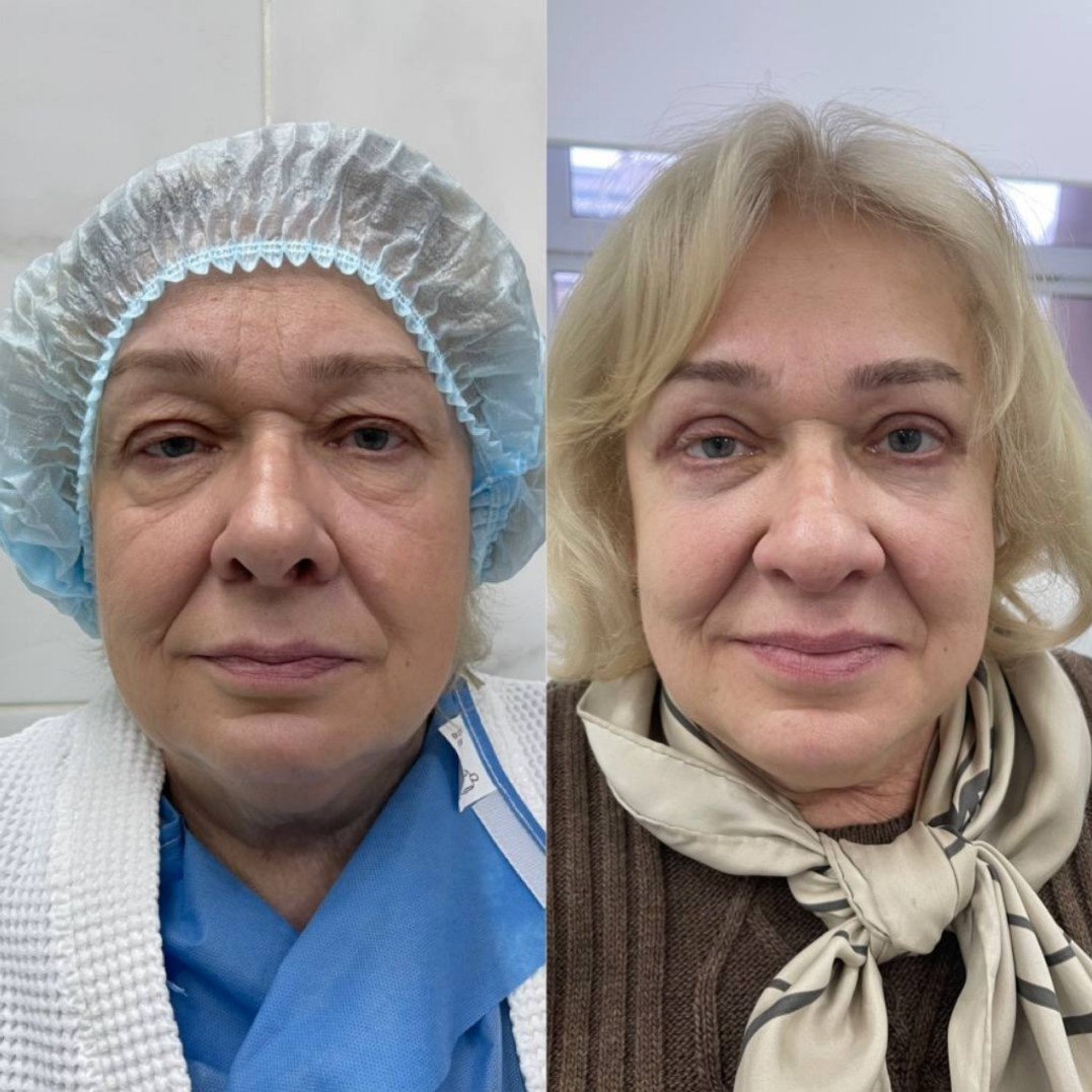 1 месяц после верхней и нижней блефаропластики