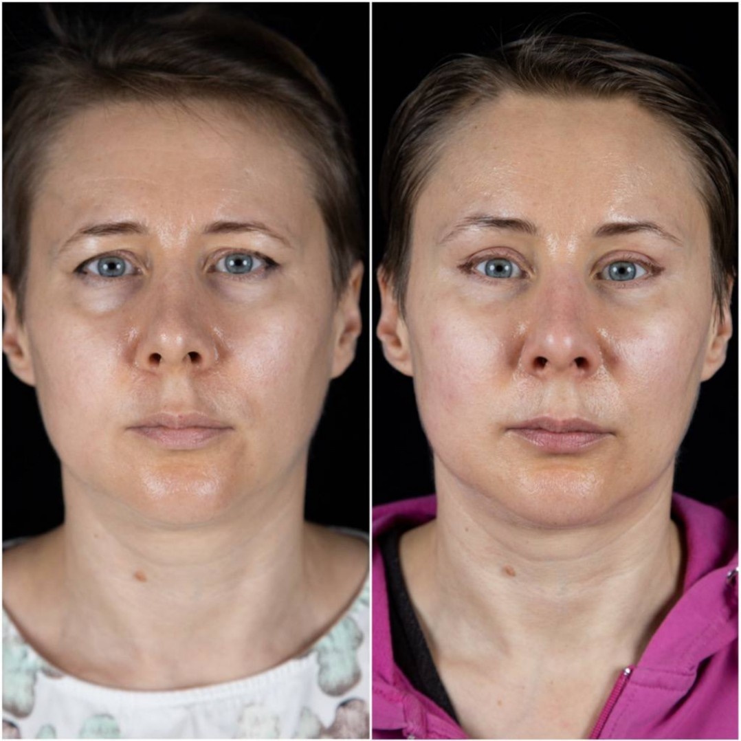 2 месяца после операции: эндоскопическая подтяжка лба, верхняя блефаропластика, трансконьюктивальная блефаропластика+пинч, первый этап липолифтинга лица