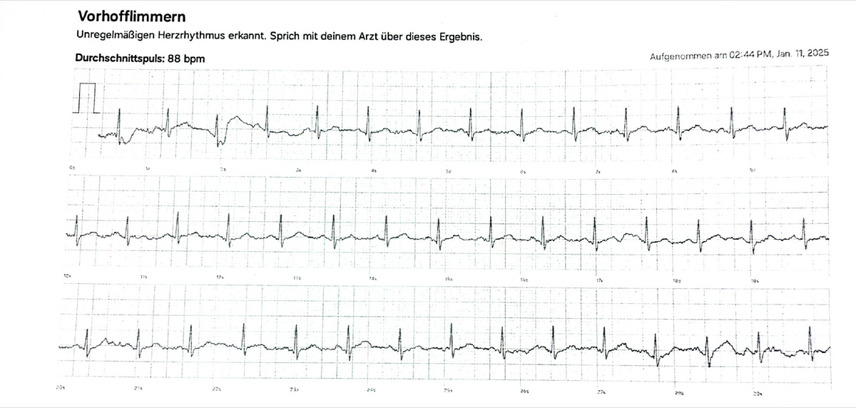 Умные часы ошибочно интерпретировали ЭКГ и поставили пациенту диагноз фибрилляции предсердий.