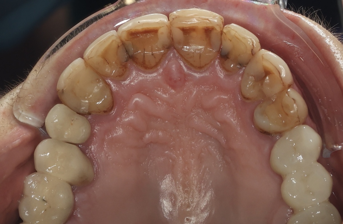 Кариес под пломбами/винирами