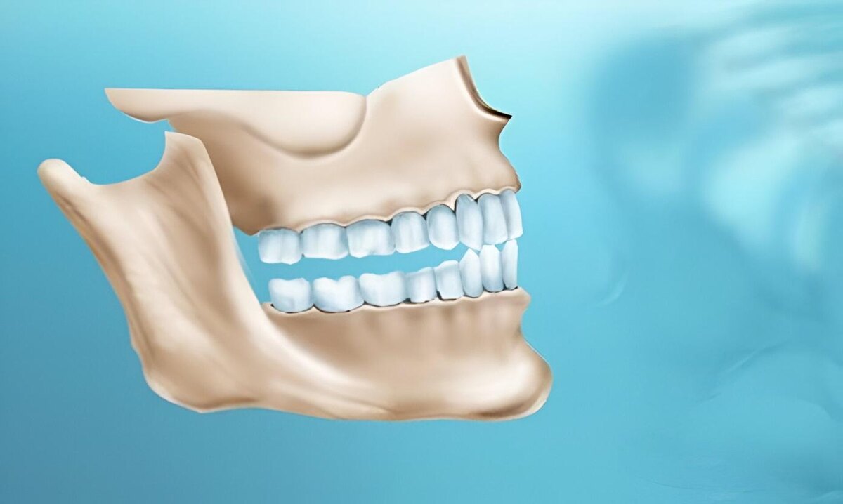 Нарушение окклюзии в боковых отделах
