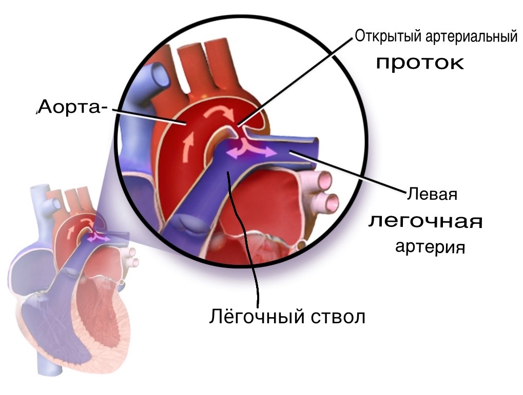 Схематичное расположение боталлова протока