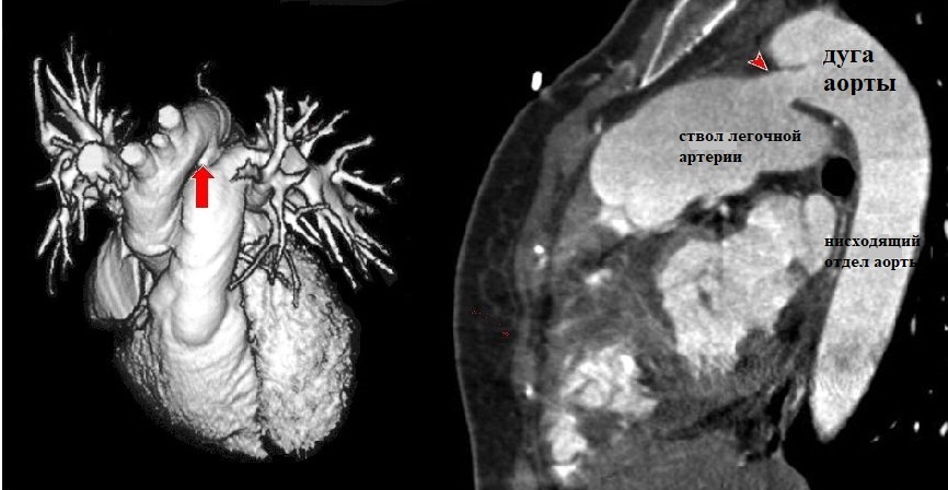 Объемная (слева) и сагиттальная (справа) реконструкции сердца и магистральных сосудистых стволов: стрелкой показан функционирующий шунт (возможности КТ-ангиографии)