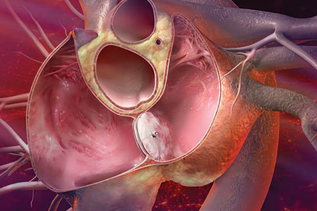 Окклюдер в межпредсердной перегородке при коррекции открытого овального окна