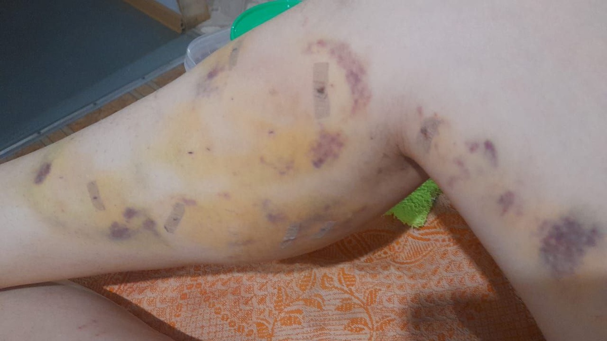 Места уколов заклеиваем Omnistrip. Бежевые пластыри настолько тонкие и маленькие, что некоторые Пациенты их даже не замечают. В этих пластырях можно мыться под душем. 