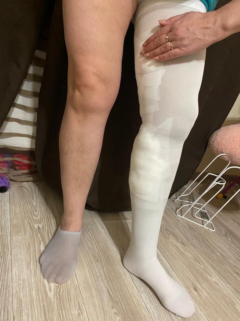 Поверх бежевых укладываются стерильные марлевые салфетки и наклеиваем белый пластырь Omnifix (на фото он просвечивает под чулком). Эти повязки пациент снимает на 3 сутки после операции самостоятельно. 