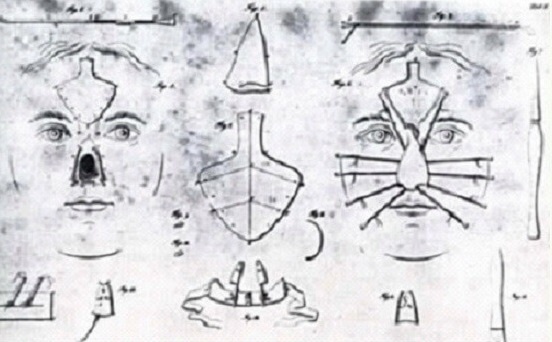 Древнеиндийский способ ринопластики