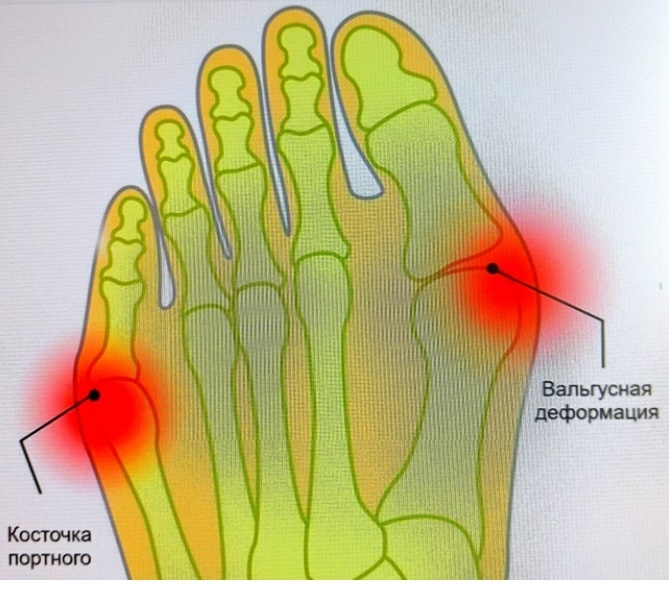 Как тесная обувь меняет вашу стопу.